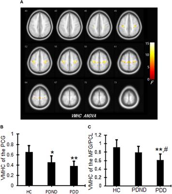Alterations of Interhemispheric Functional Connectivity in Parkinson’s Disease With Depression: A Resting-State Functional MRI Study